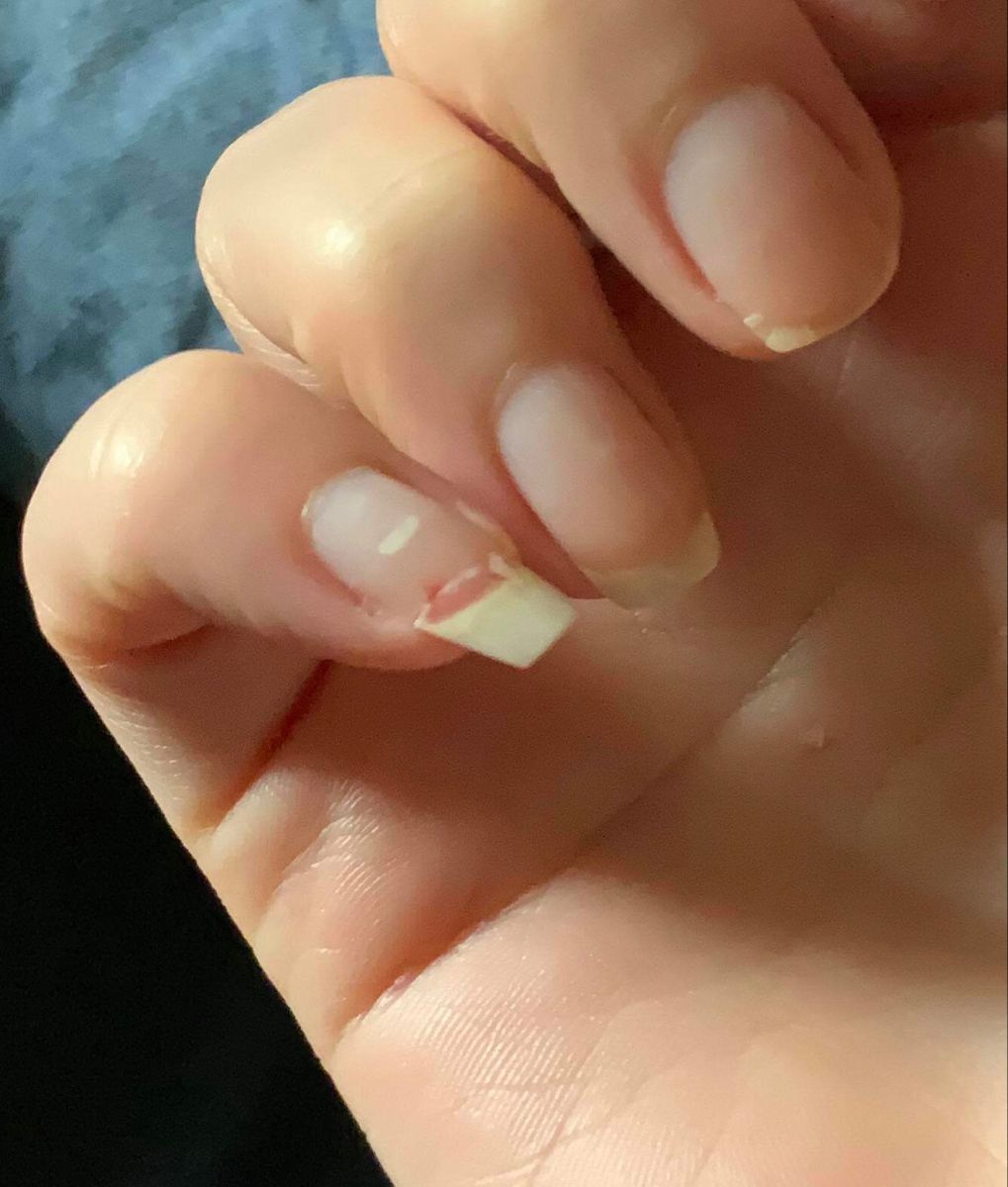 Unhas quebradiças